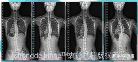 2、右胸弯、左腰弯多见