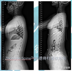 6、大部脊柱侧弯患者会出现矢状面的平背畸形（胸椎后凸减少）